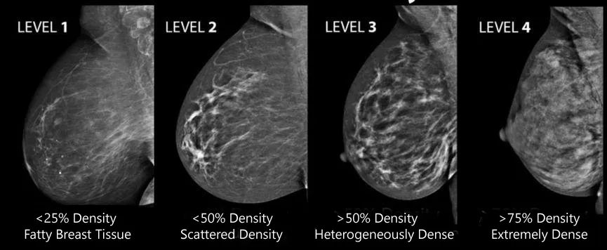 different density level of breast cancer
