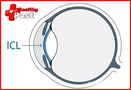 The icl lens