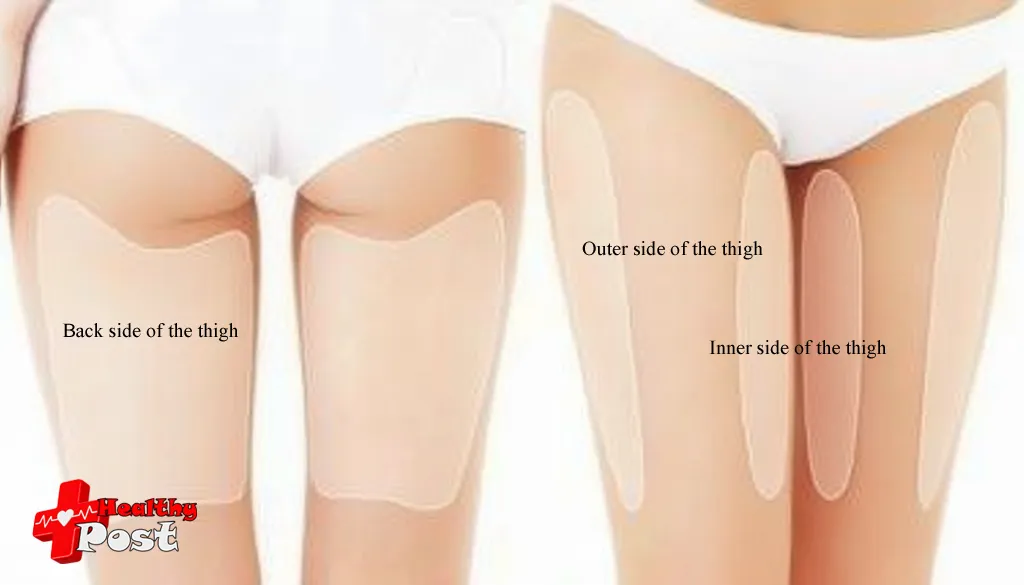 leg liposuction