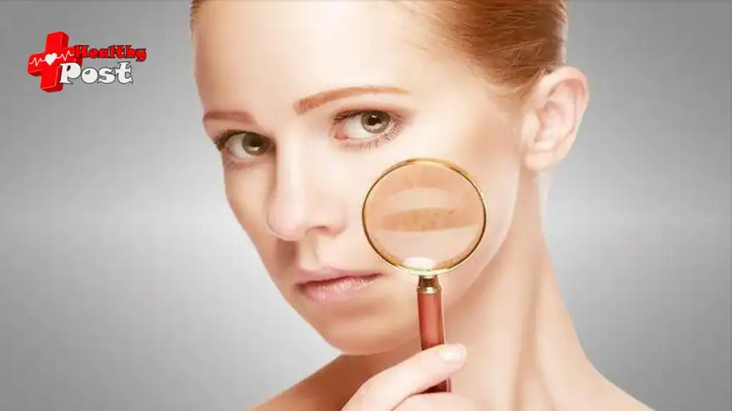What is melasma and how to treat melasma? melasma