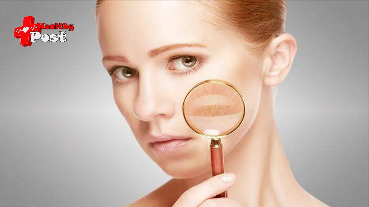 melasma