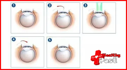 myopia surgery