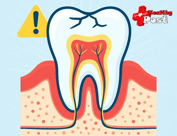 tooth enamel erosion causes