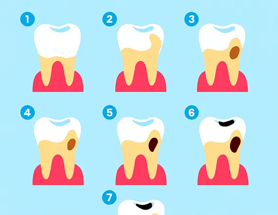 tooth enamel erosion causes