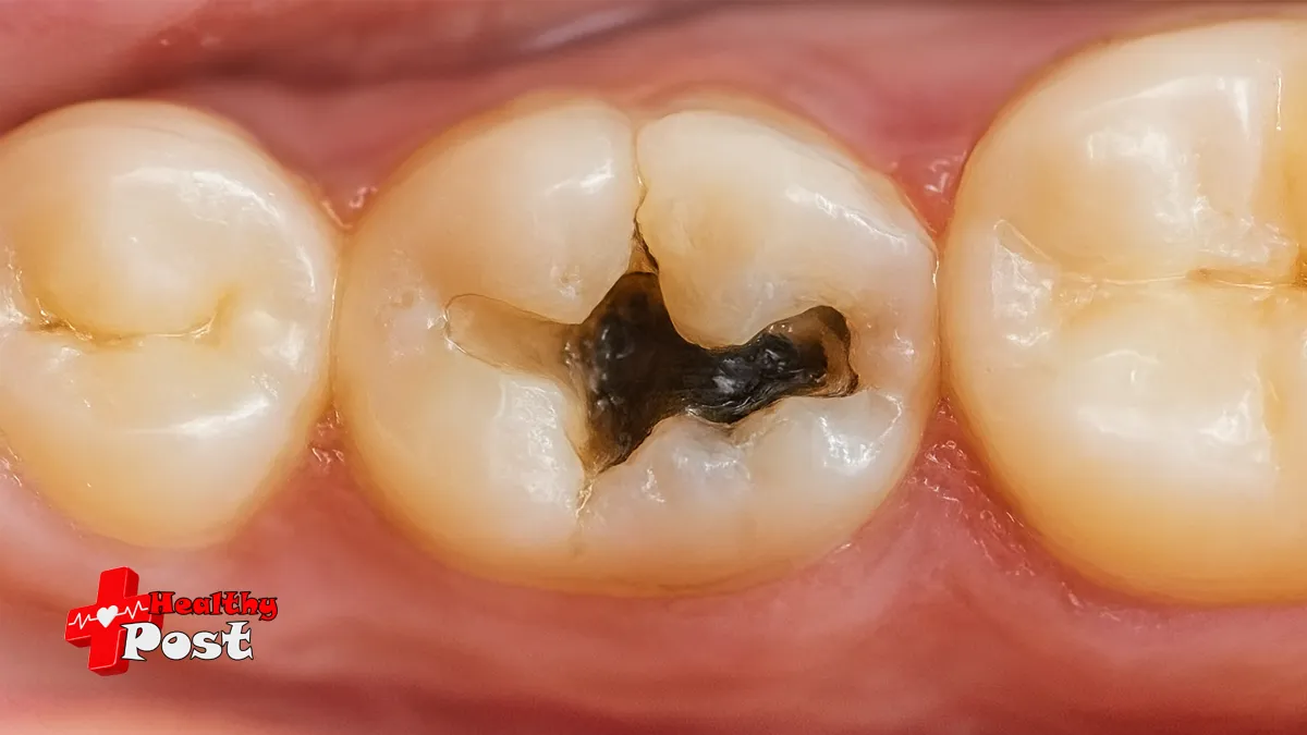 what does a cavity look like