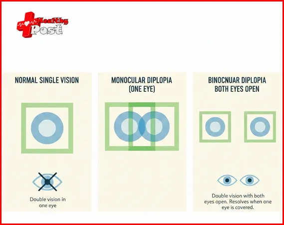 visual comparison of normal vision, monocular diplopia, and binocular diplopia