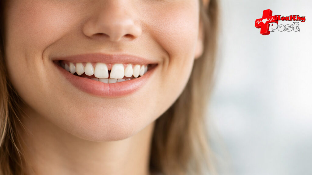 diastema teeth