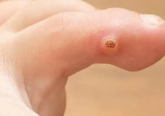 swimming pool warts