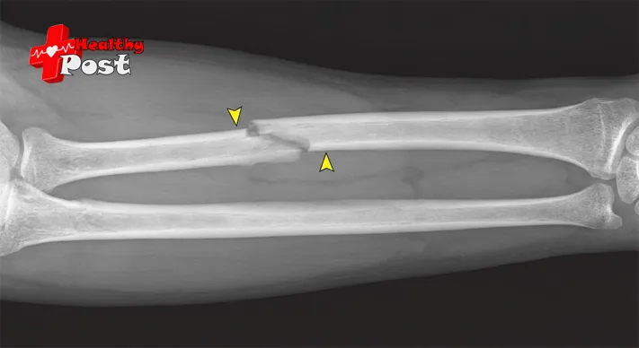 How to Identify a Bone Fracture on an X-Ray: 4 Key Clues 2 Grayscale forearm X-ray illustration showing a smooth white bone outline with one small step-shaped break in the cortex marked by a yellow arrow (How to Identify a Bone Fracture on an X-Ray)