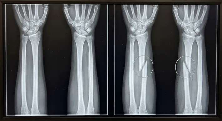 How to Identify a Bone Fracture on an X-Ray: 4 Key Clues 3 Two forearm X-rays side by side, a normal bone on the left and a bone with an oblique fracture line and slight angulation on the right