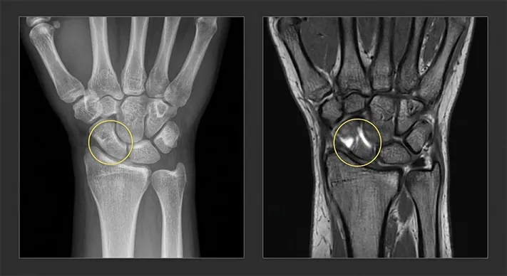 How to Identify a Bone Fracture on an X-Ray: 4 Key Clues 4 Split image of a wrist X-ray with no obvious fracture beside a wrist MRI showing a bright area in the scaphoid bone