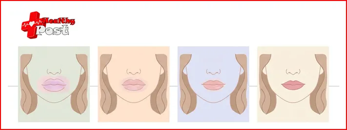 Four-panel illustration showing lips gradually going from swollen and bruised to settled over the course of recovery